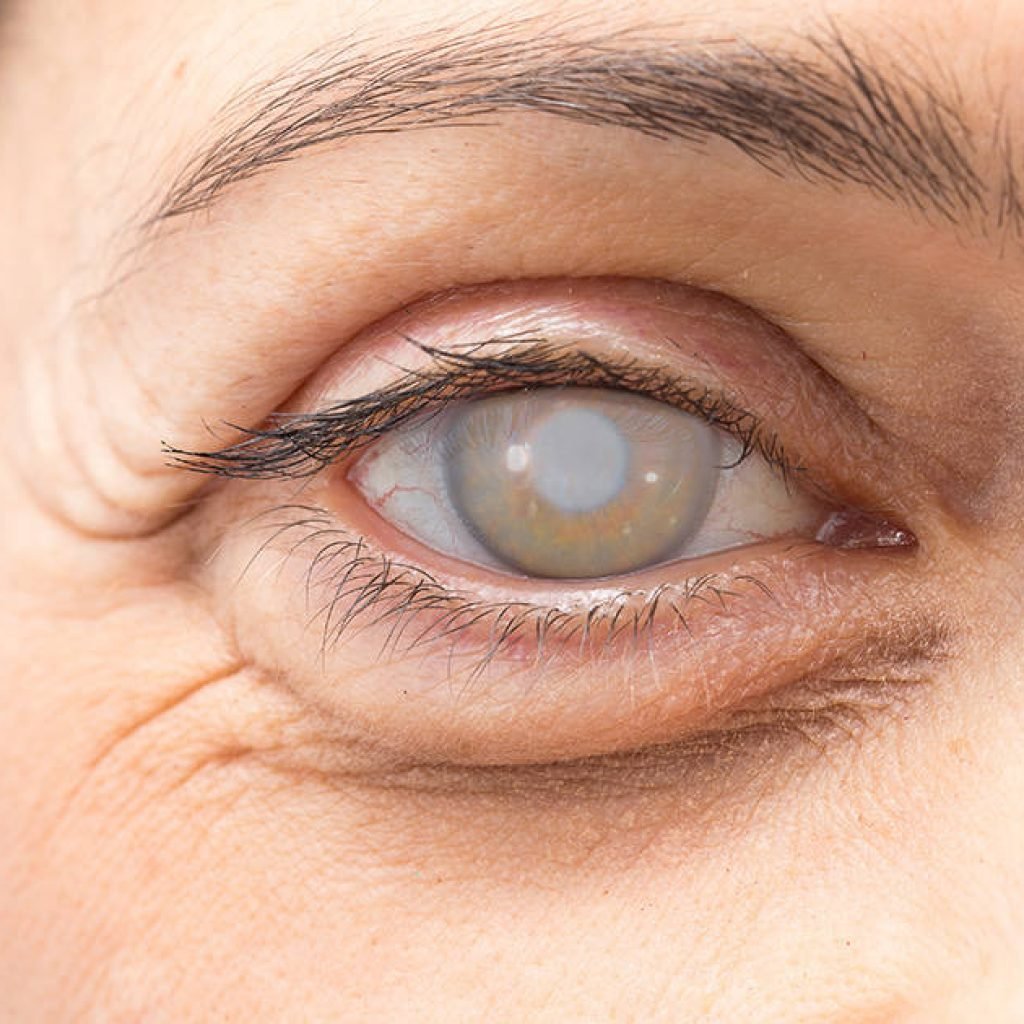 cataract-surgery-complications-1200x630_compressed-1024×1024-1 cataract-surgery-complications-1200x630_compressed-1024x1024-1